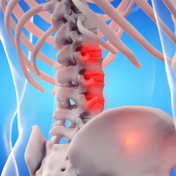 ankylosing spondylitis chiropractor in Charlotte NC