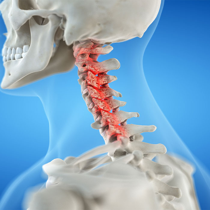 bone spur treatment in Charlotte NC