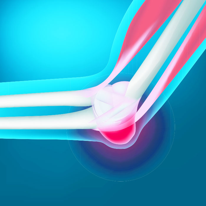 bursitis chiropractor in Charlotte NC