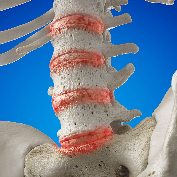 degenerative disc disease treatment in Charlotte NC
