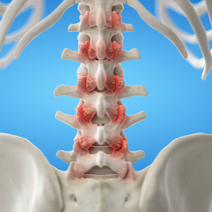 facet joint syndrome treatment in Charlotte NC