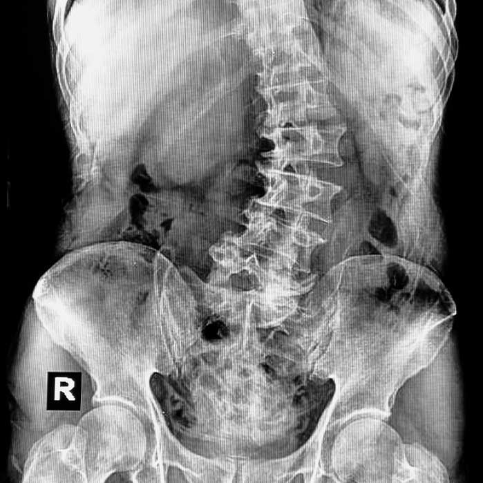 scoliosis chiropractor in Charlotte NC