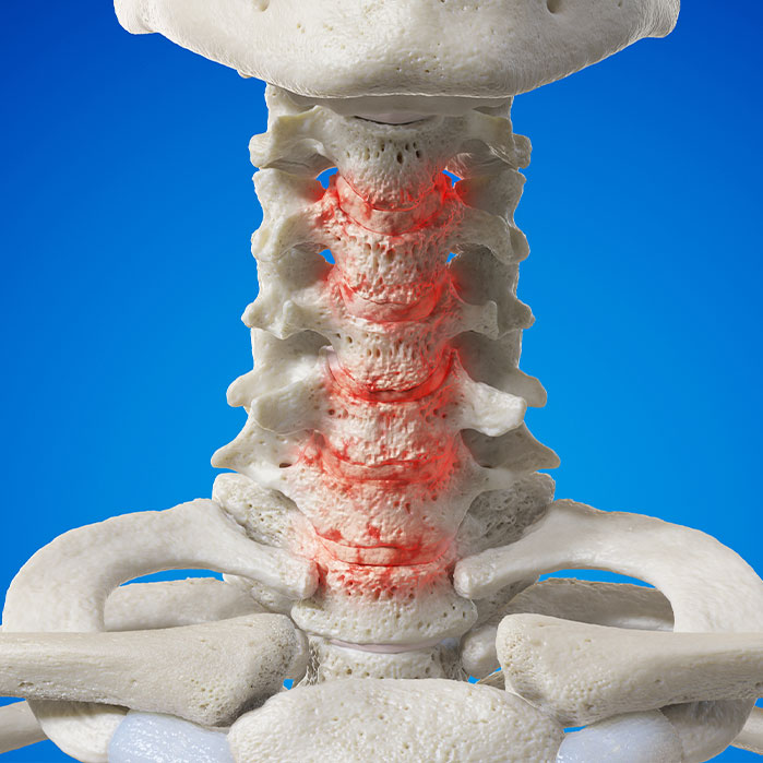 spondylosis treatment in Charlotte NC