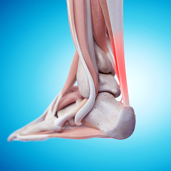 tendonitis chiropractor in Charlotte NC